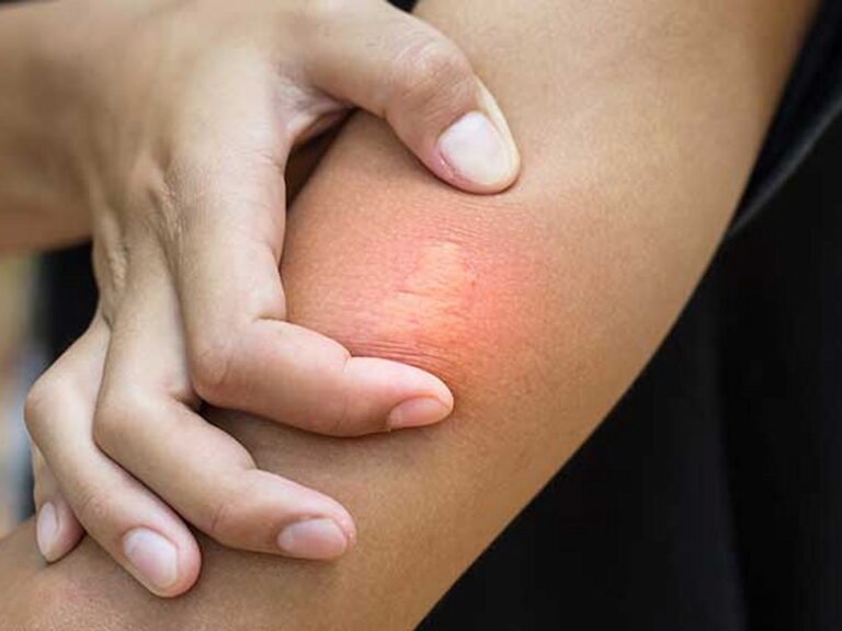 An arm with an irritated bump from a bug bite, a common cause of allergy triggers.
