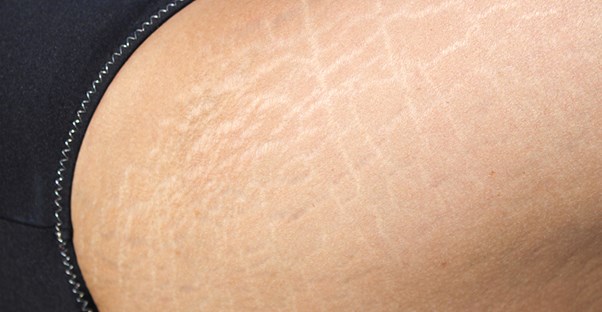 The beginnings of cellulite
