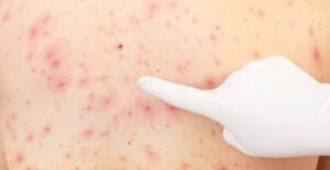 An adult with shingles