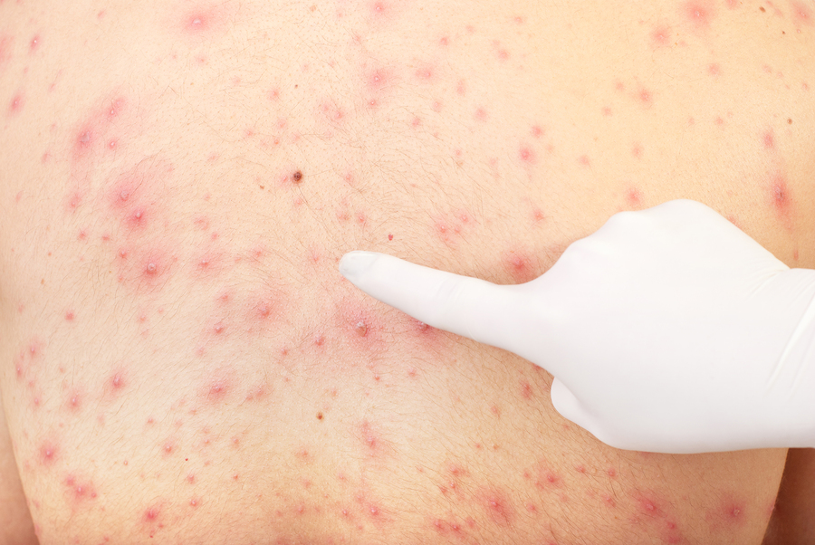 When to See a Doctor About Shingles