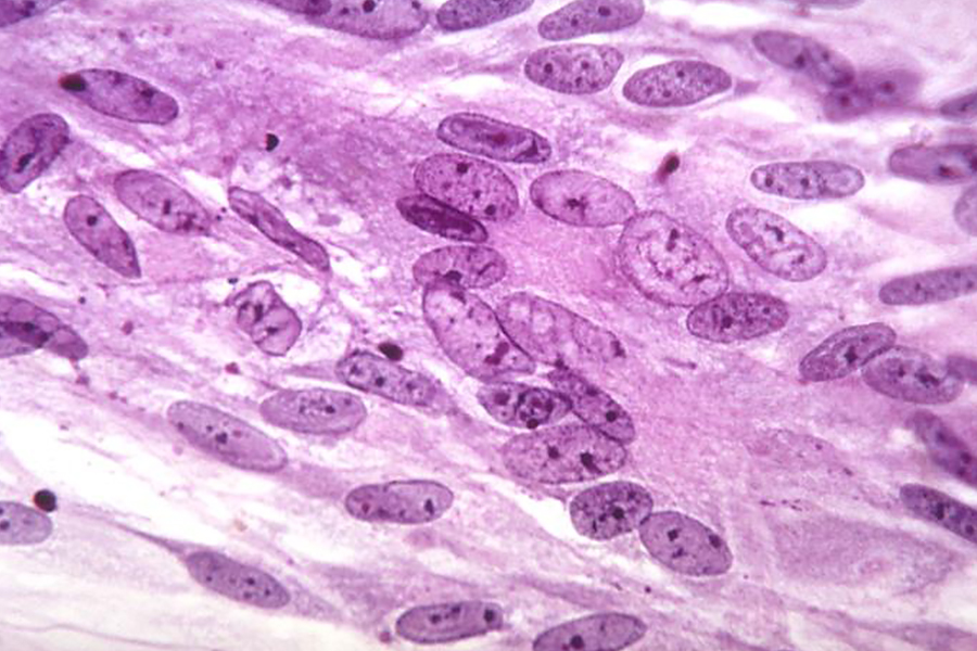 Shingles Causes