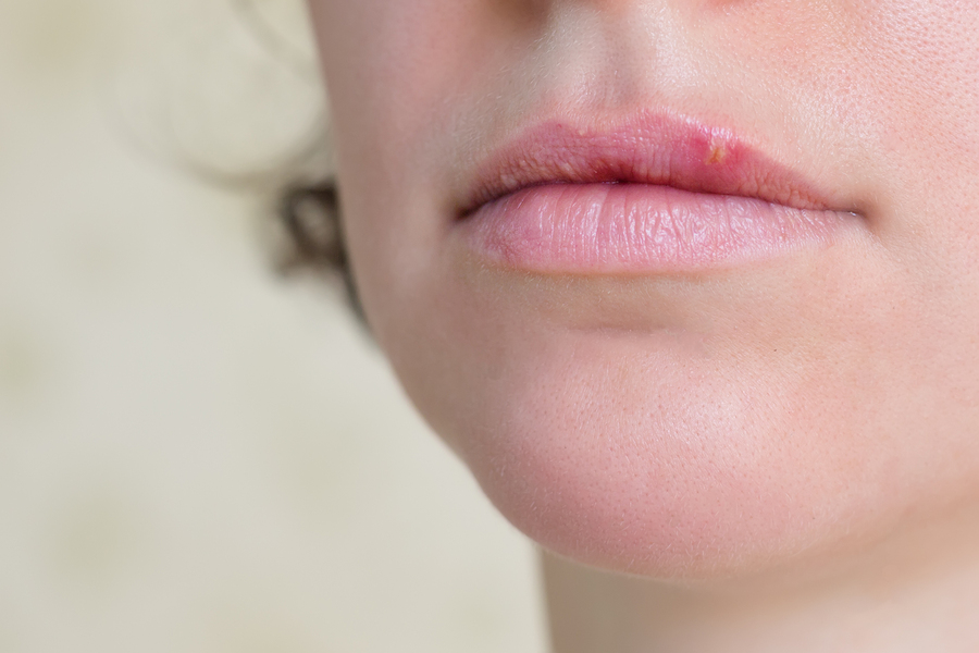Shingles and the Herpes Virus