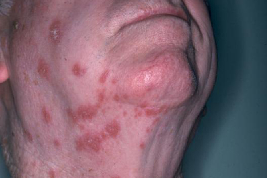 Shingles Symptoms