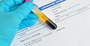 A hepatitis test
