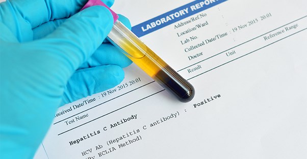 A hepatitis test