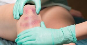 A large bruise on a patient's knee