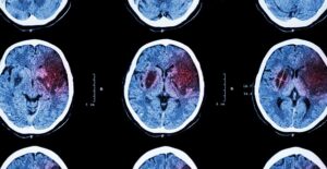 A brain scan
