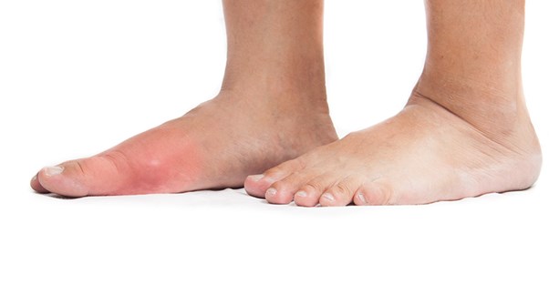 An affected foot