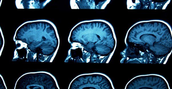 A brain scan