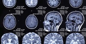 An x-ray of the brain