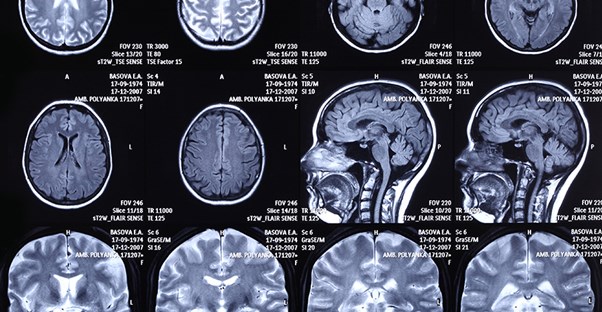 An x-ray of the brain