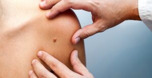 A doctor examines melanoma