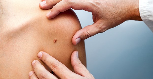 A doctor examines melanoma