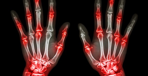 A gout ridden x-ray