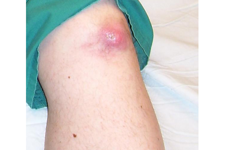 Advanced Gout