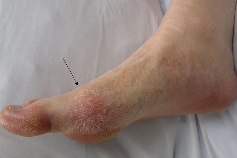 Gout Symptoms