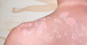 Some bad sunburn blisters