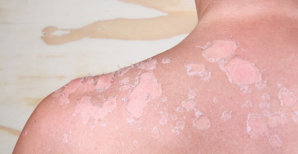 Some bad sunburn blisters