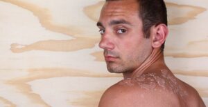 A man with a severe sunburn