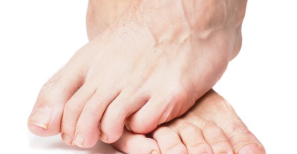 A patient with hammer toe