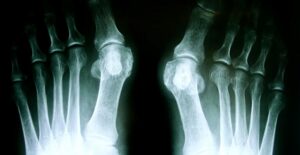 A bunion x-ray