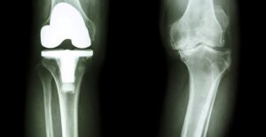 A replaced knee