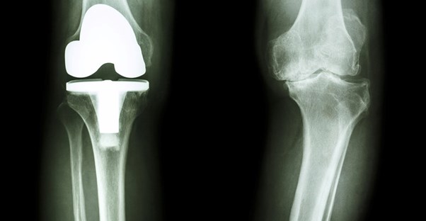 A replaced knee
