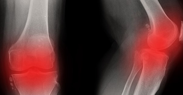 A broken bone