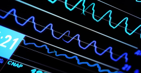 An EKG