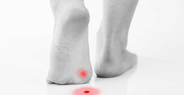 A bright red plantar wart