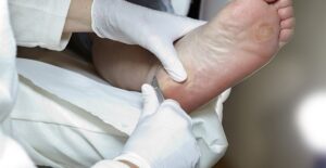A doctor treats plantar warts