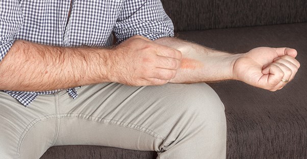 Dermatitis on arm