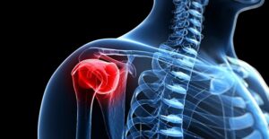 rotator cuff surgery