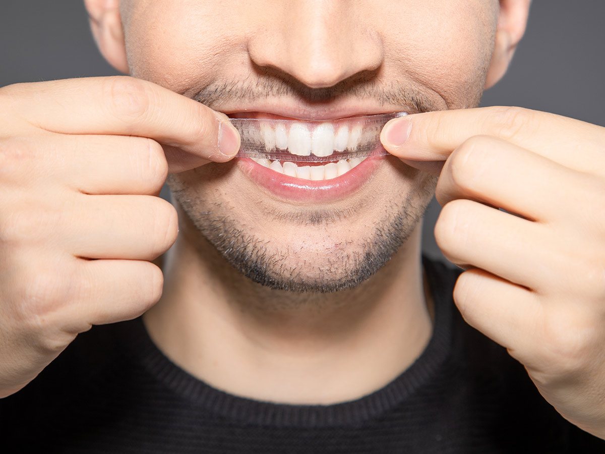 Teeth Whitening