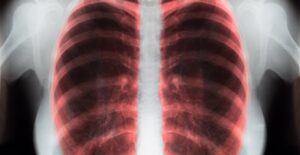 an x-ray of a lung shows how COPD treatment is working