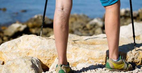 varicose veins in legs