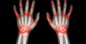 arthritis symptoms highlighted on an x-ray of hands