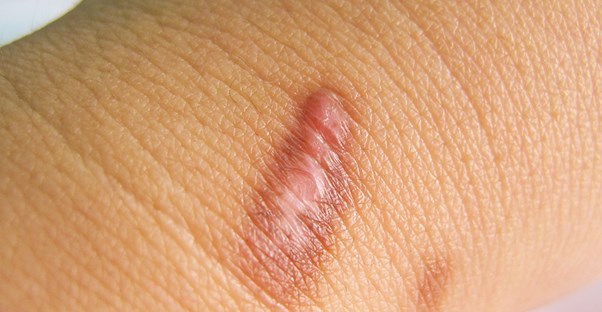 scar on back of neck and person is considering scar removal