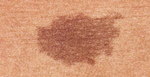 types of birthmarks