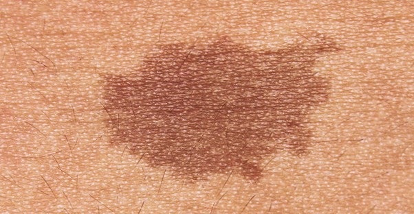 types of birthmarks