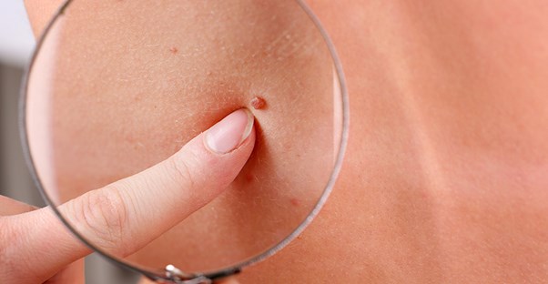 myths about birthmarks