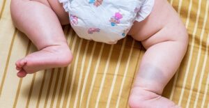 baby birthmark