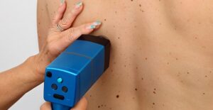 birthmark removal
