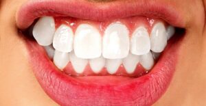 person with bruxism grinding their teeth