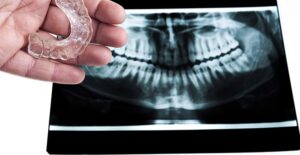 bruxism guard and xray of the mouth showing bruxism