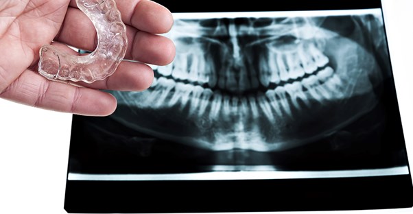 bruxism guard and xray of the mouth showing bruxism