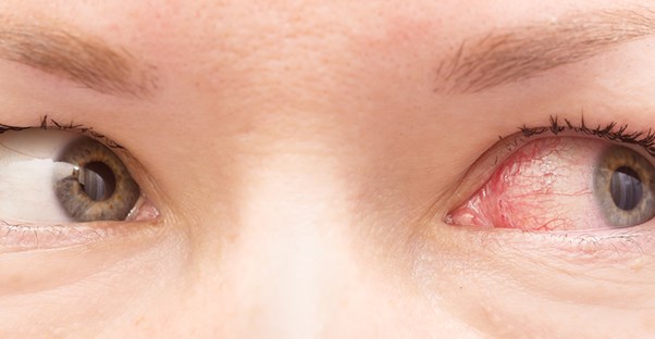 itchy eyes caused by allergies