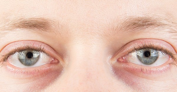 guy using home remedies to cure dry eyes