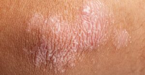 an area of psoriasis is shown on the elbow of an individual