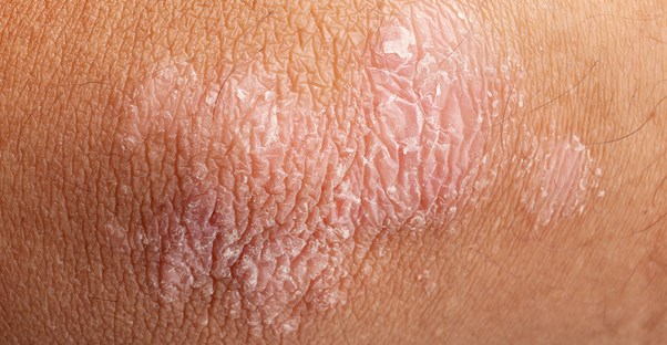 an area of psoriasis is shown on the elbow of an individual